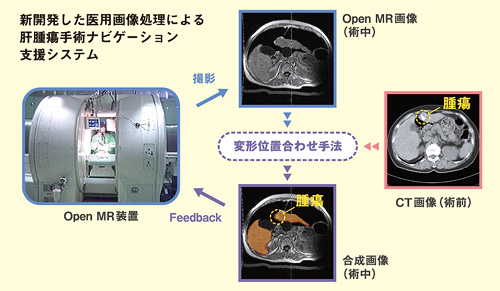 新開発した医療画像処理による肝腫瘍手術ナビゲーション支援システム